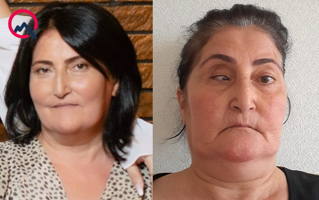 Bu klinika təzminat ödəyəcək - Burun düzəldəndə gözü zədələyib - FOTO