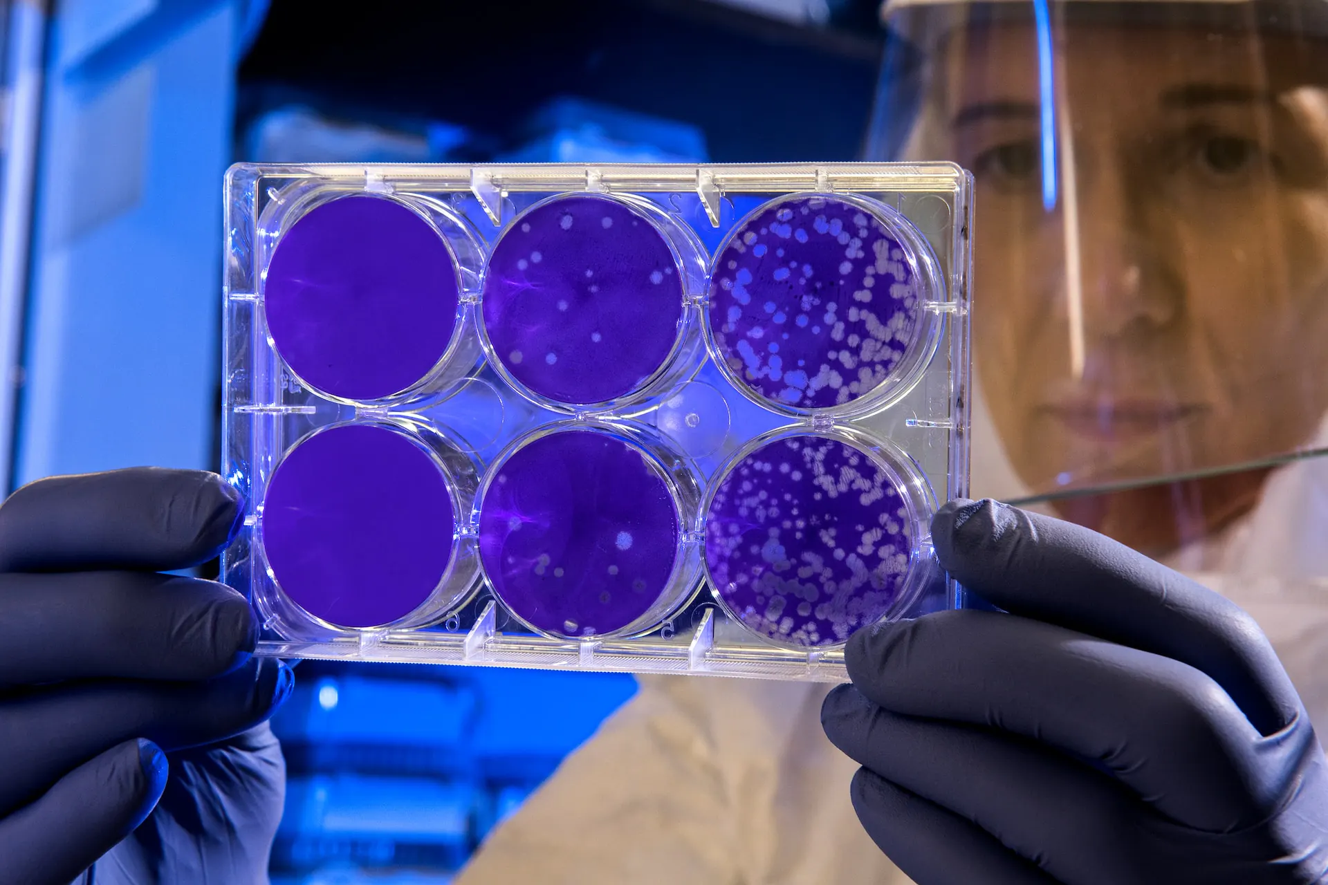 Çilidə bütün müasir antibiotiklərə davamlı bakteriyalar aşkar edilib