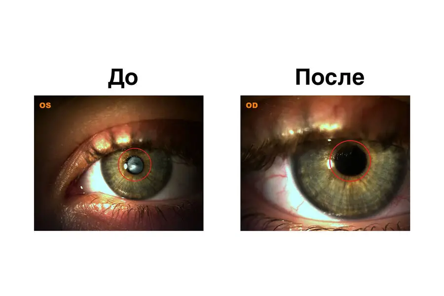 Həkimlər diabetdən kor olan qızın görmə qabiliyyətini bərpa ediblər