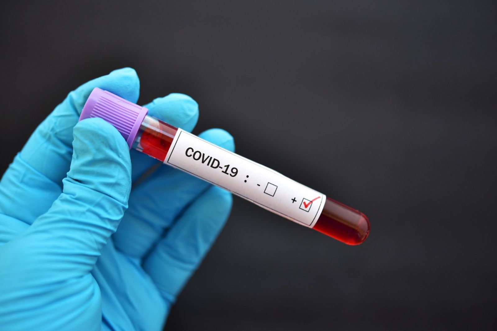 Koronavirus dünyada gözlənilən ömür uzunluğunu 1,5 il azaldıb